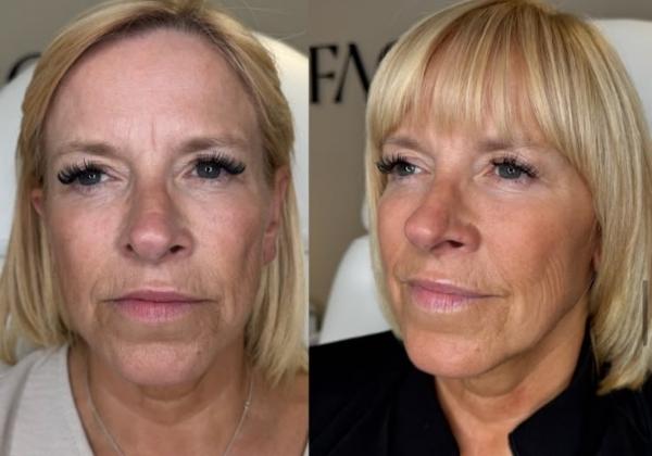 Full face botox results from Facebox in East London