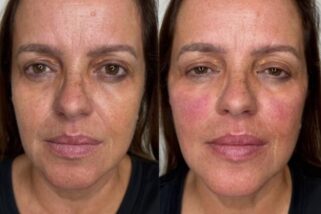 4ml-filler-package-leytonstone 4ml dermal filler transformation package in Leytonstone, East London at Facebox London