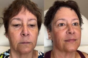 HIFU-leytonstone HIFU treatment results from Facebox London in Leytonstone