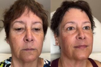 HIFU treatment results from Facebox London in Leytonstone