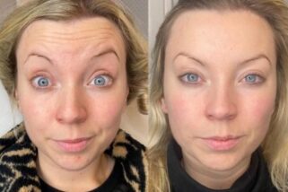 botox-east-london
