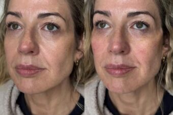 cheek-filler-leytonstone Cheek filler by Facebox London in Leytonstone