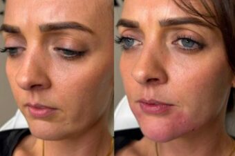 chin-filler-leytonstone Chin filler by Facebox in Leytonstone, Easy London