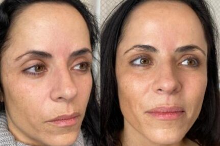 Facial Rejuvenation in East London facial-rejuvenation-east-london