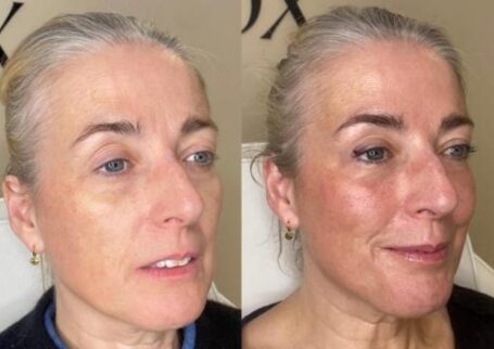 filler-and-botox-package-east-london