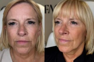 Full face botox results from Facebox in East London