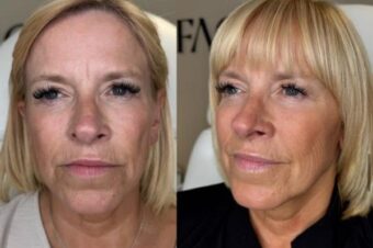 Full face botox results from Facebox in East London