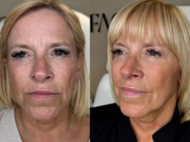 Full face botox results from Facebox in East London
