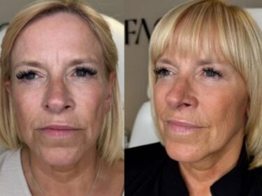 Full face botox results from Facebox in East London