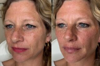 full-face-restoration-with-dermal-filler-leytonstone Full face restoration with dermal fillers at Facebox in Leytonstone, East London