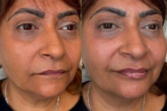 lip-filler-leytonstone Lip filler in East London as Facebox aesthetics clinic in Leytonstone
