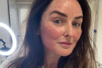 Immediately after Microneedling results at Facebox London in Leytonstone