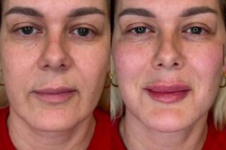 mid-to-lower-face-restoration-with-dermal-filler-leytonstone Mid and lower face restoration with dermal fillers at Facebox in Leytonstone, East London