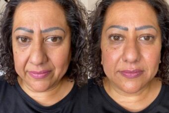 nasolabial-folds-filler-leytonstone