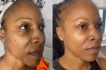 Skin booster results in Leytonstone at Facebox in East London