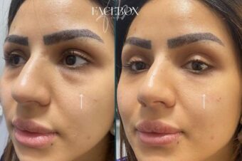 tear-trough-filler-leytonstone Tear trough filler at Facebox London aesthetic clinic in Leytonstone